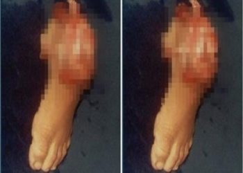 Mãe amputa o pé do filho de 3 anos com machado para receber seguro do INSS