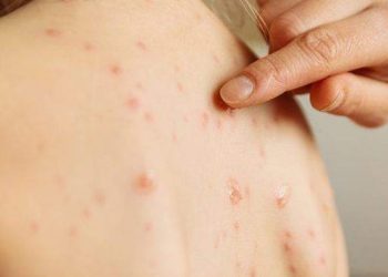 Primeiro caso importado de sarampo no Espírito Santo é confirmado