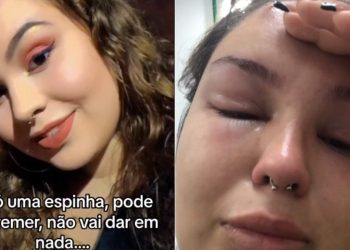Jovem vai parar no hospital após espremer espinha e contrair infecção bacteriana grave